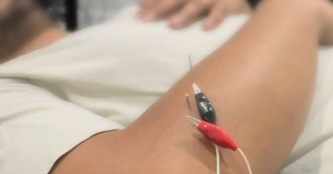 Dry Needling